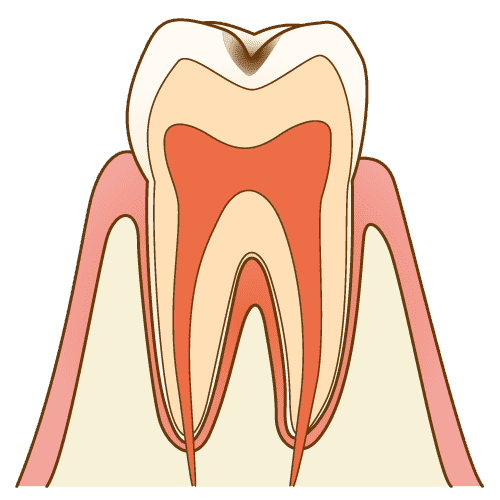 歯表面の軽い脱灰