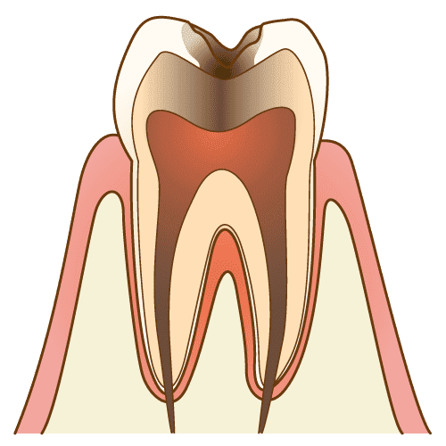 象牙質の脱灰