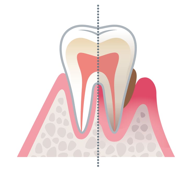 歯周病の原因
