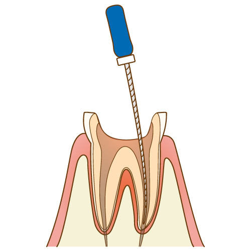 国立　歯医者　根管治療