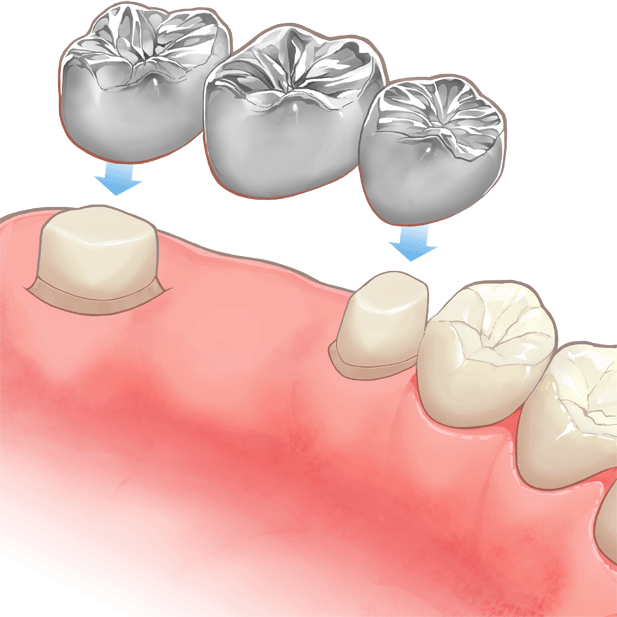 国立　歯医者　ブリッジ