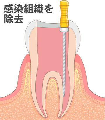 国立　歯医者　根管治療　RCT