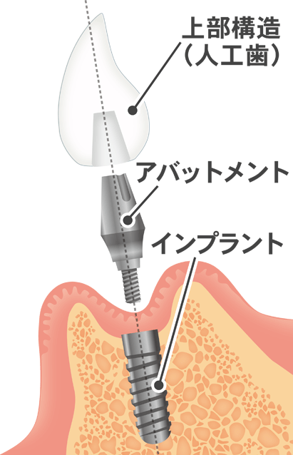 国立　歯医者　インプラント