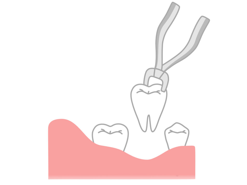 国立　歯医者　抜歯