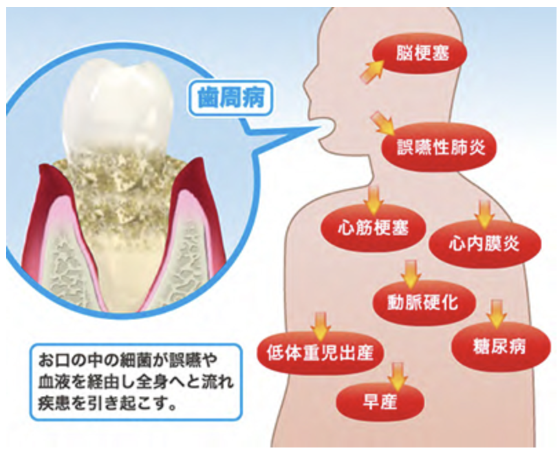 国立　歯医者　歯周病　全身への影響