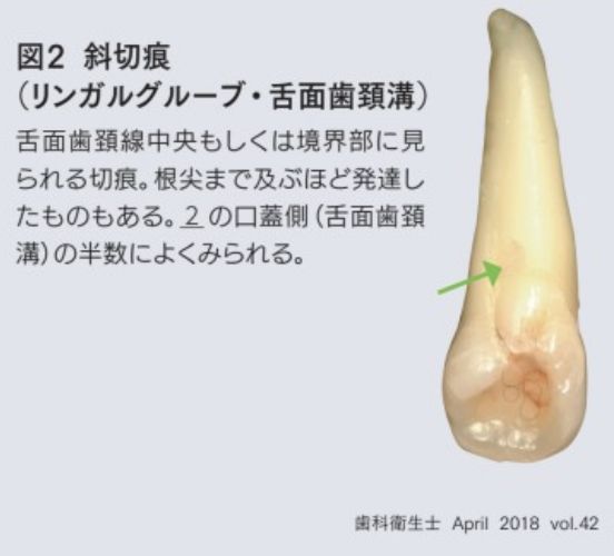 国立　歯医者　斜切痕