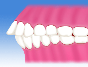 国立　歯医者　不正咬合