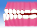 国立　歯医者　不正咬合