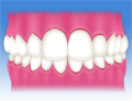 国立　歯医者　不正咬合