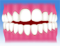 国立　歯医者　不正咬合