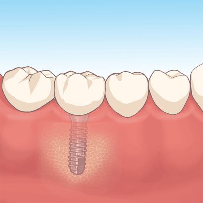 国立　歯医者　インプラント