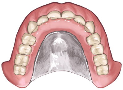国立　歯医者　金属床義歯