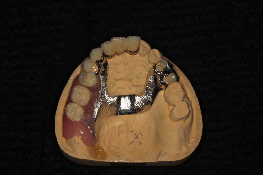国立　歯医者　部分床義歯