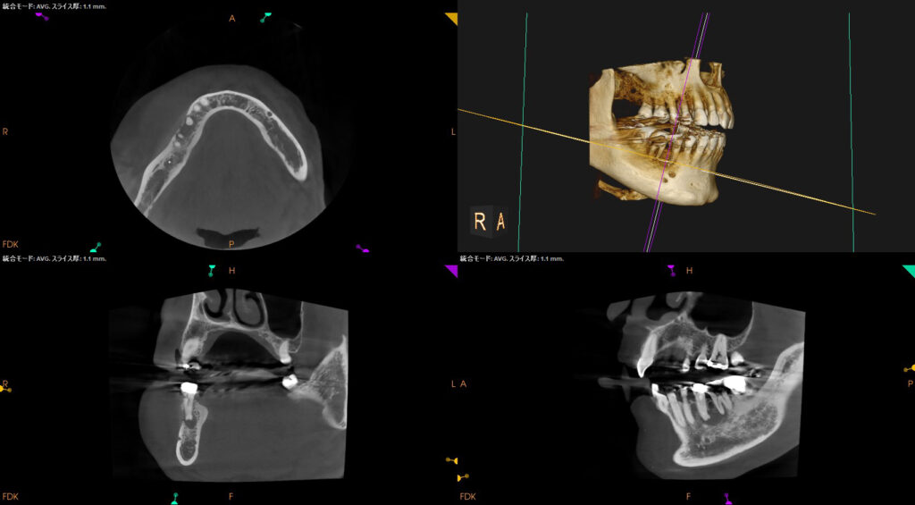 国立　歯医者　CT