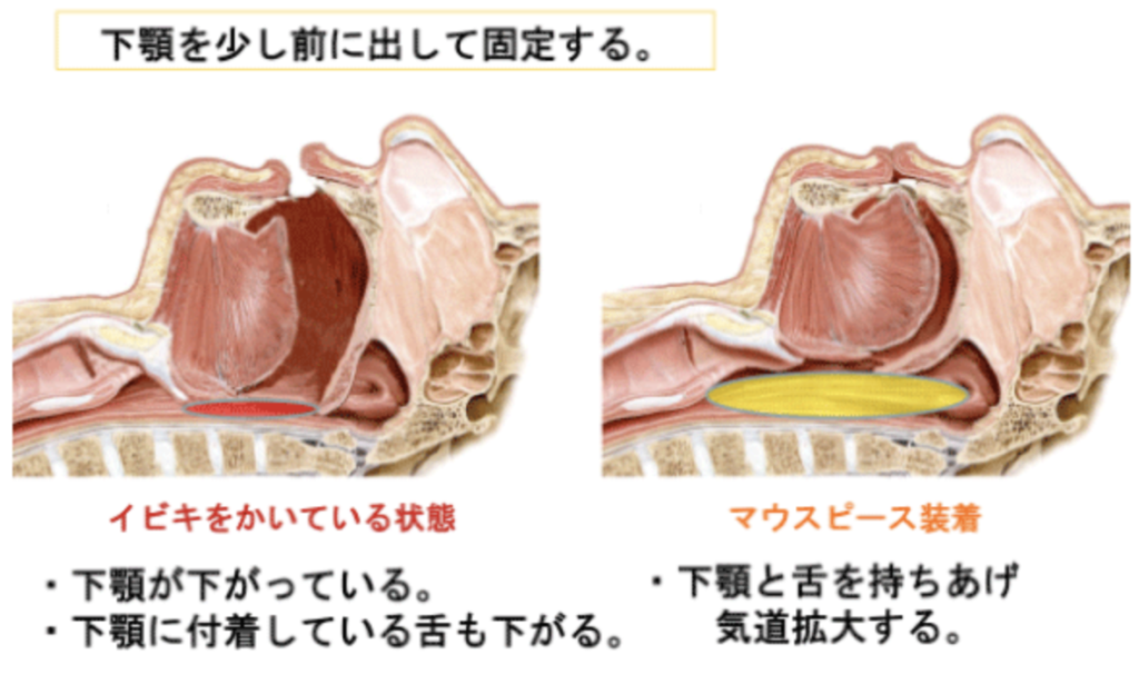 国立　歯医者　睡眠時無呼吸症候群