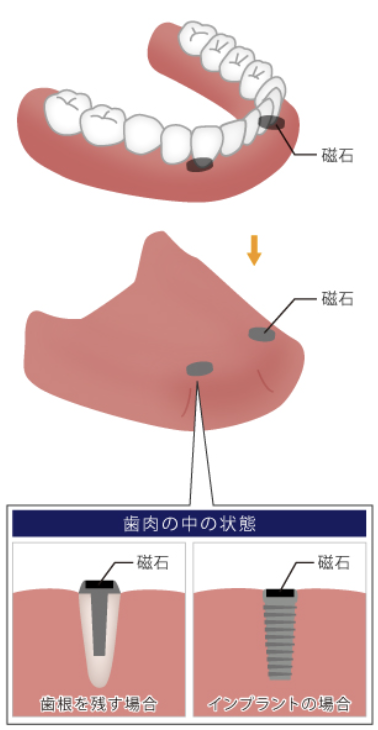 国立　歯医者　アタッチメント