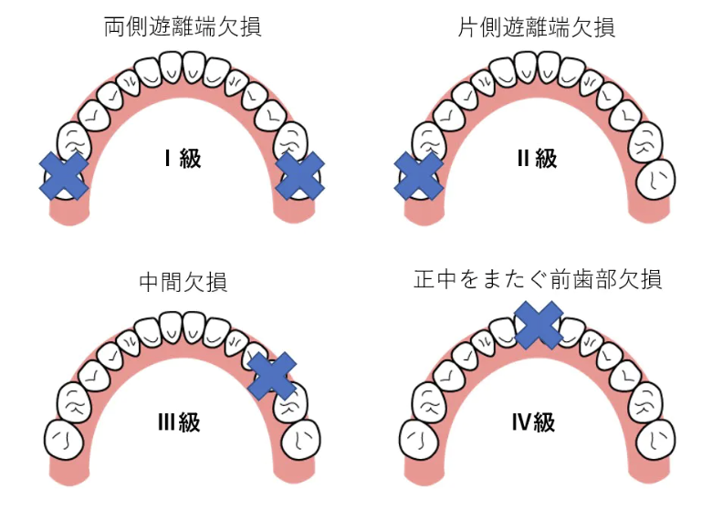 国立　歯医者　ケネディの分類