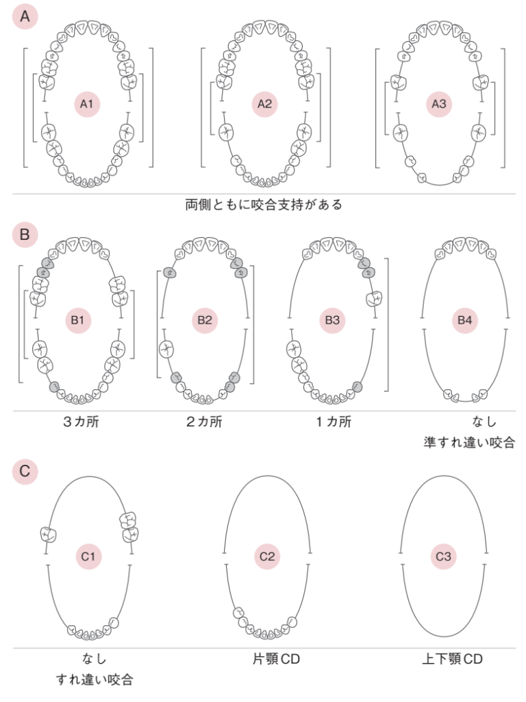 国立　歯医者　アイヒナーの分類