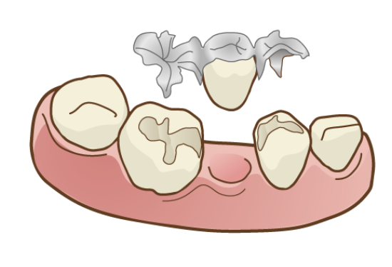 国立　歯医者　インレーブリッジ