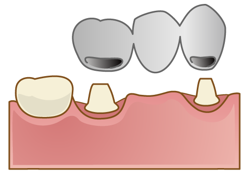 国立　歯医者　欠損放置