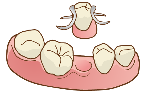 国立　歯医者　欠損放置