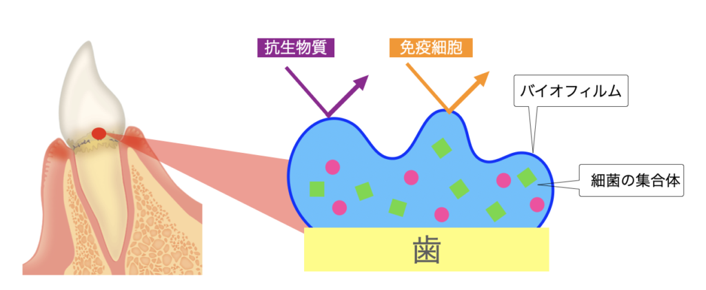 国立　歯医者　バイオフィルム