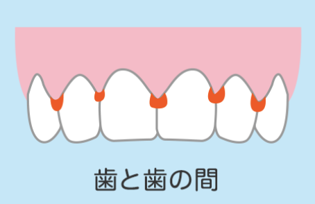 国立　歯医者　磨き残し