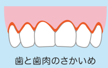 国立　歯医者　磨き残し