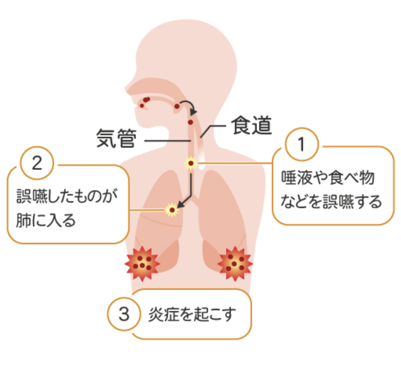 国立　歯医者　誤嚥