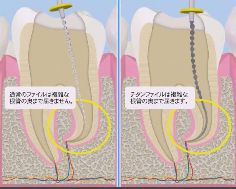 国立　歯医者　根管治療