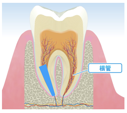 国立　歯医者　根管治療