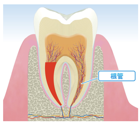 国立　歯医者　根管治療