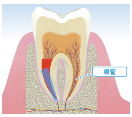 国立　歯医者　根管治療