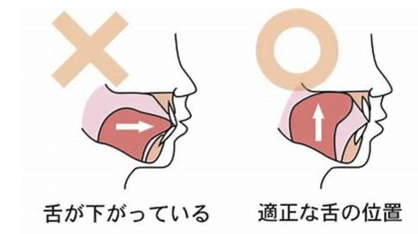 国立　歯医者　口呼吸