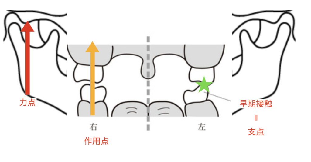 国立　歯医者　犬歯