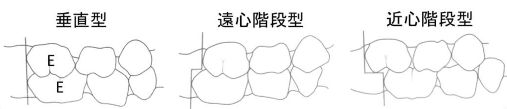 国立　歯医者　空隙