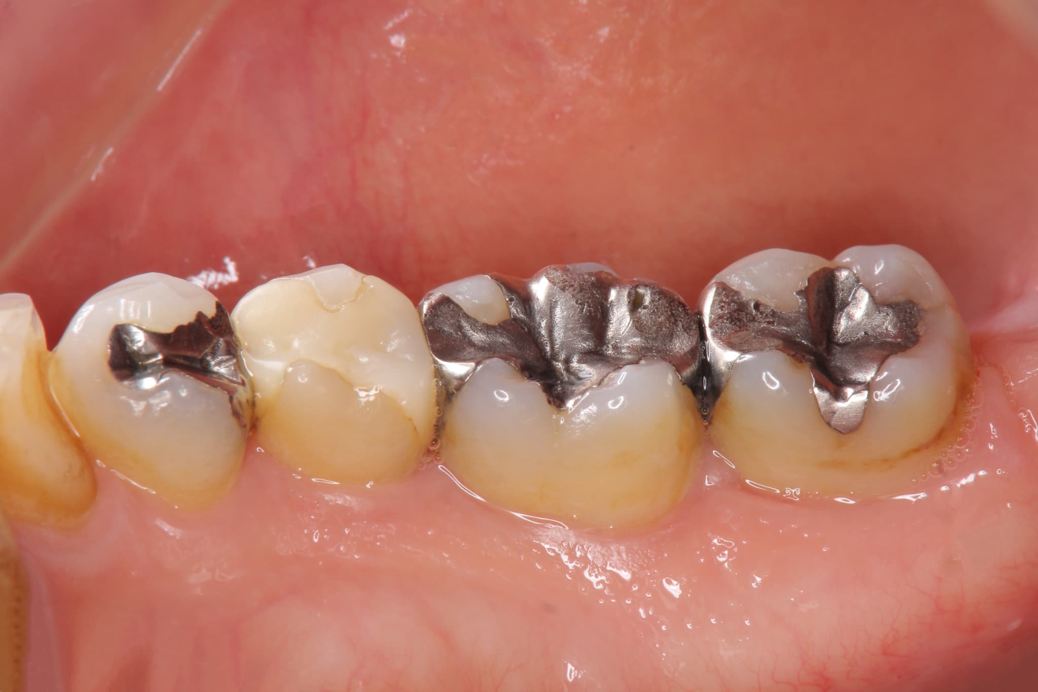 銀歯で治療した歯