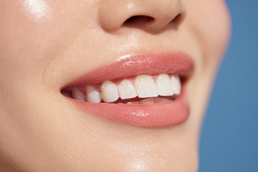 審美歯科治療によって綺麗になった女性の歯